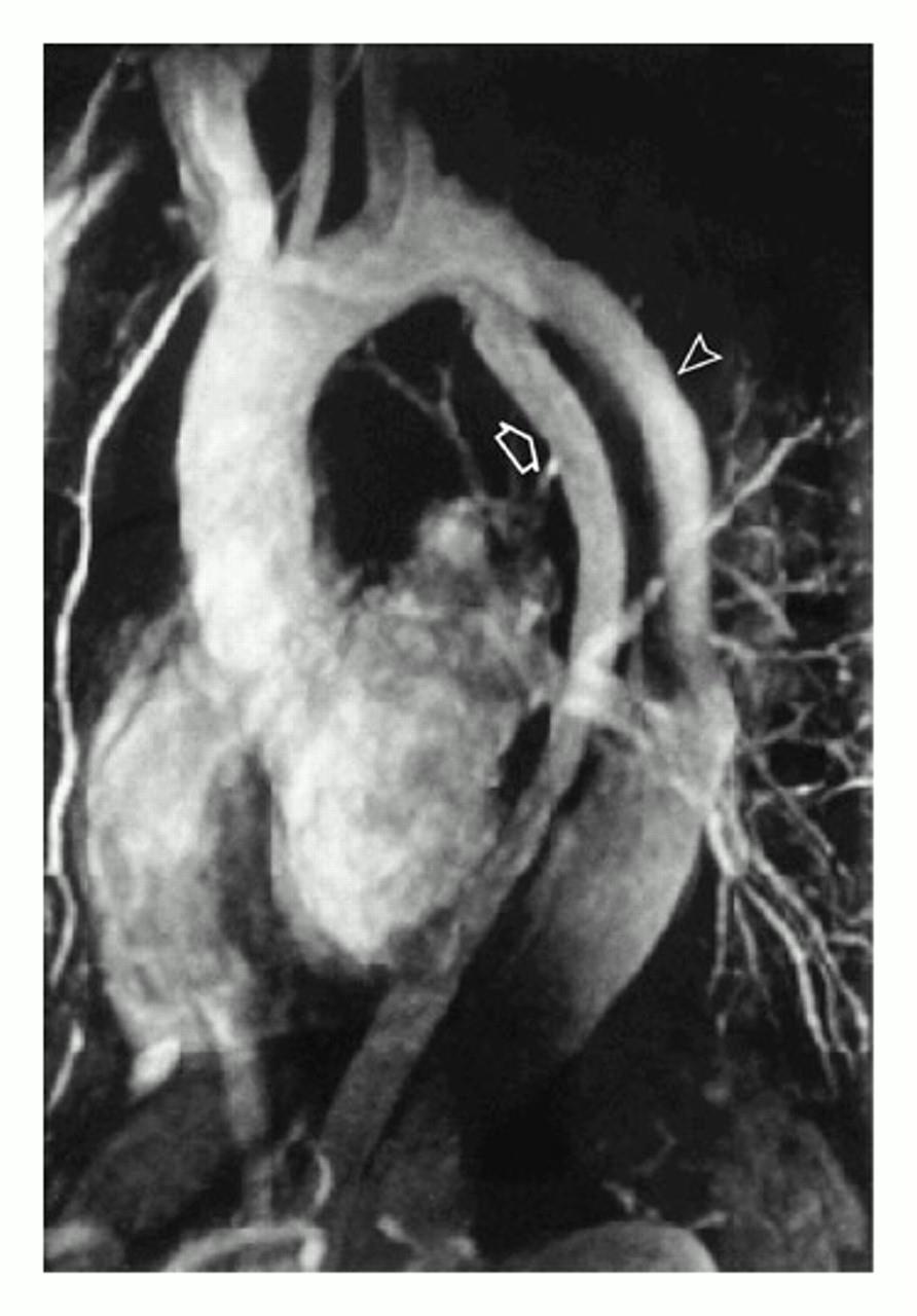 Magnetic Resonance Angiograms