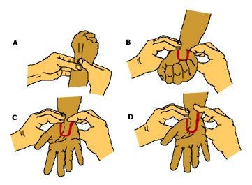 Thrombangitis