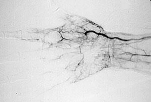 Thrombangitis