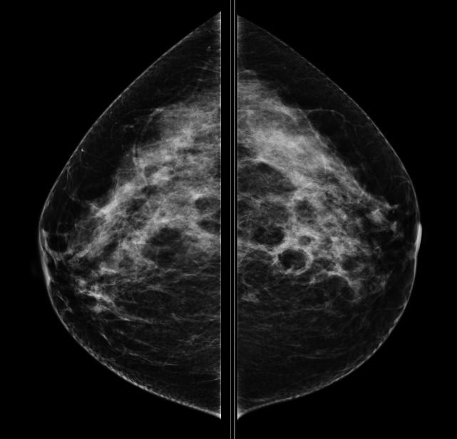 A B C Rycina 2. Chora lat 30. Pierś lewa: invasive carcinoma NST N2, NG2. A.