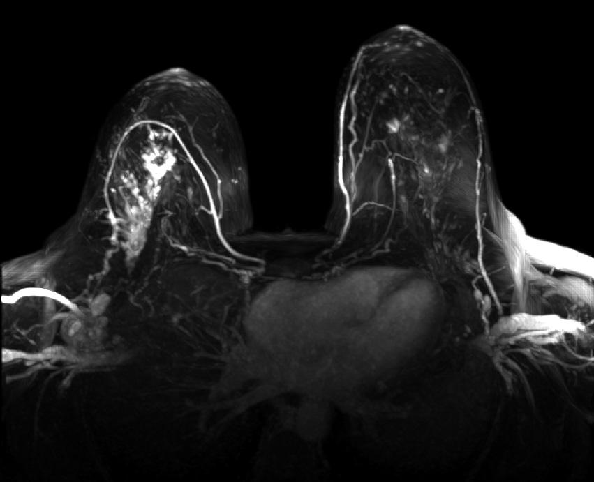 Badanie MR piersi rekonstrukcja MIP (maxsimum intensity projection) w kwadrancie górnym