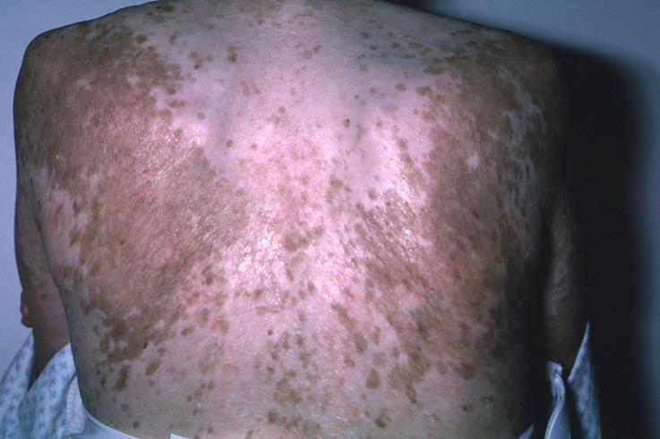 Objawy diagnostyczne cgvhd: skóra