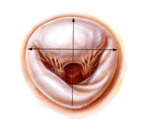 Plastyka zastawki mitralnej Korekcja kształtu, funkcji płatków i aparatu podzastawkowego
