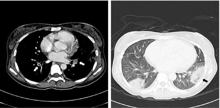 Obustronna zatorowość płucna (tętnice dolne płuc, zawał płuc) 36 letnia chora z TRU + APS leczona skutecznie UFH, t-pa, następnie