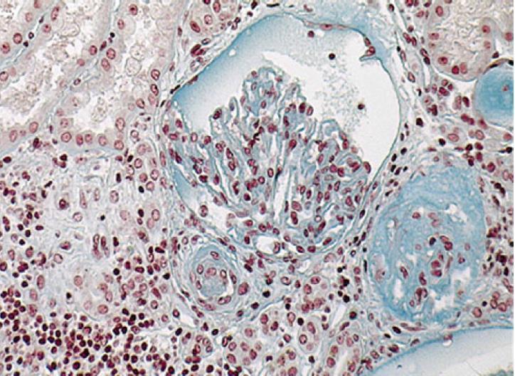 Nefropatia APS -FIH Biopsja nerki chorego na TRU i apl