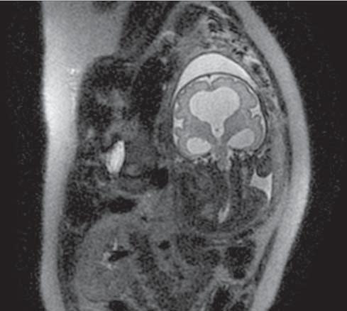 T. Golus et al. Przydatność diagnostyczna rezonansu magnetycznego w obrazowaniu wad rozwojowych nicznych jest nadal przedmiotem wielu badań [7,8].