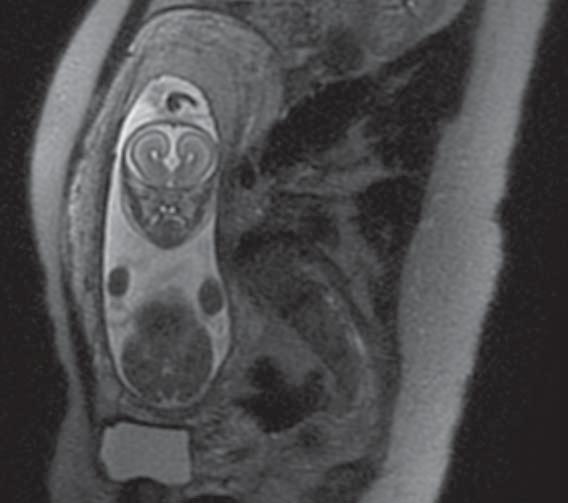 ciała modzelowatego [,2], anomalie tylnego dołu czaszki [3], zaburzenia rozwoju kory mózgowej [2], zmiany krwotoczne [4] i inne nabyte in utero patologie [5], wady dysraficzne, ze szczególnym