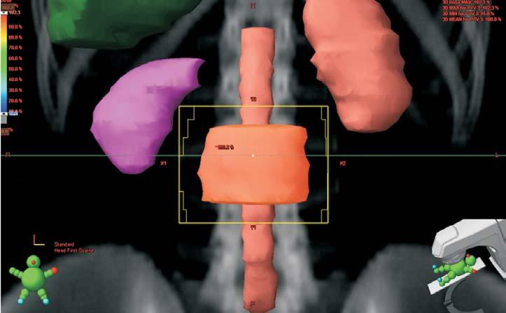 24 M. BIEDKA, E. MUDA a delay may allow repeating the same scheme of the systemic therapy.