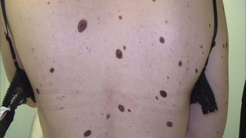 Forum Dermatologicum 2019, tom 5, nr 2 Rycina 1.