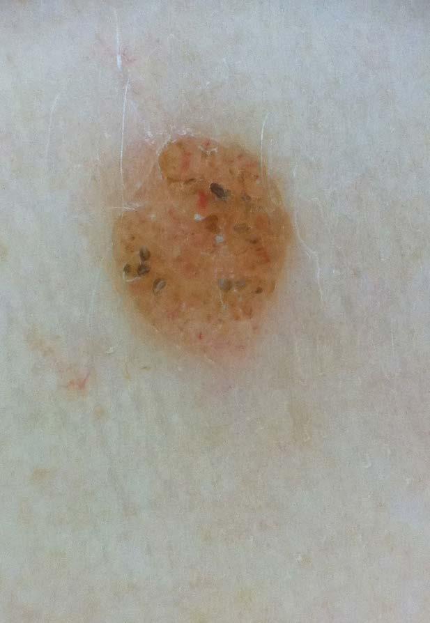 Forum Dermatologicum 2019, tom 5, nr 2 Rycina 4.