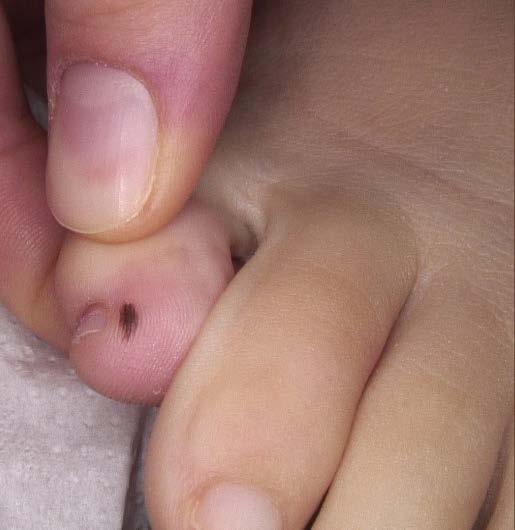 koresponduje z obecną w bruzdach melaniną, wskazując na prawidłowy, łagodny wzorzec ułożenia barwnika w bruzdach; obraz kliniczny zmiany barwnikowej (u