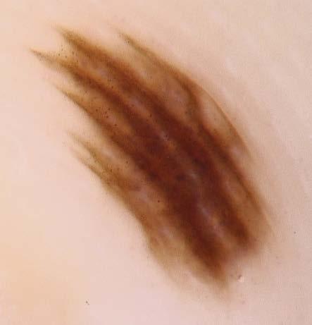 rozmieszczenia barwnika (melaniny); D w wykonanym teście z barwiącym zmywalnym markerem po jego mocnym wtarciu w skórę uzyskano wybarwienie zarówno