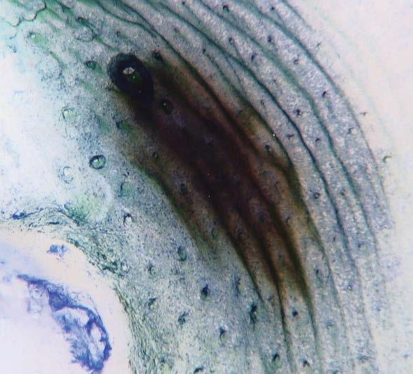 wycięto, a badanie histopatologiczne potwierdziło rozpoznanie znamienia naskórkowego Rycina 6.