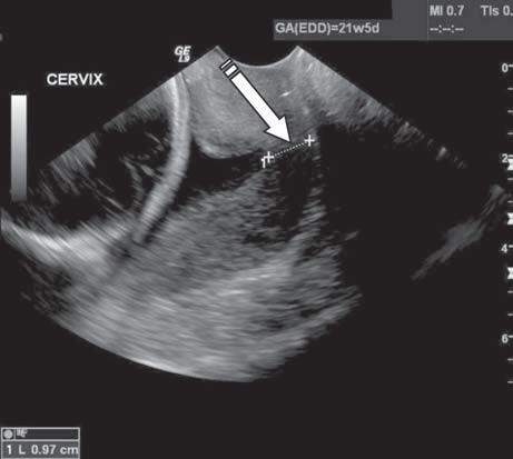 77 Badanie ultrasonograficzne szyjki macicy. Najważniejszym krokiem diagnostycznym u ciężarnych z podejrzeniem niewydolności cieśniowo szyjkowej jest badanie ultrasonograficzne szyjki macicy.