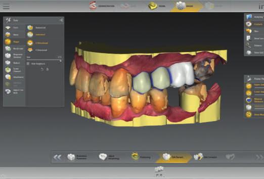 14 I 15 Szablony chirurgiczne w implantologii zintegrowanej Oprogramowanie inlab CAD pozwala projektować i produkować szablony chirurgiczne w laboratorium