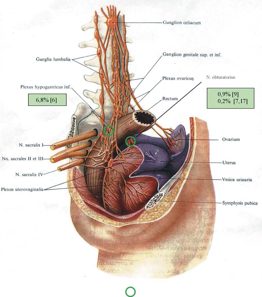 44 R. PORĘBA, J. POZOWSKI możliwość uszkodzenia nerwów possible nerves lesions Ryc. 5. Unerwienie macicy i pęcherza moczowego (wg Frankenhäusera Łasiński W.