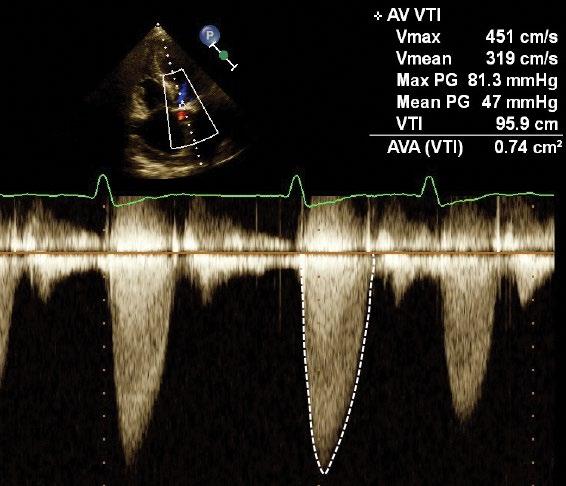 Ryc. 3. Stenoza aortalna. Spektrum przepływu w rejestracji dopplerem wiązki ciągłej.