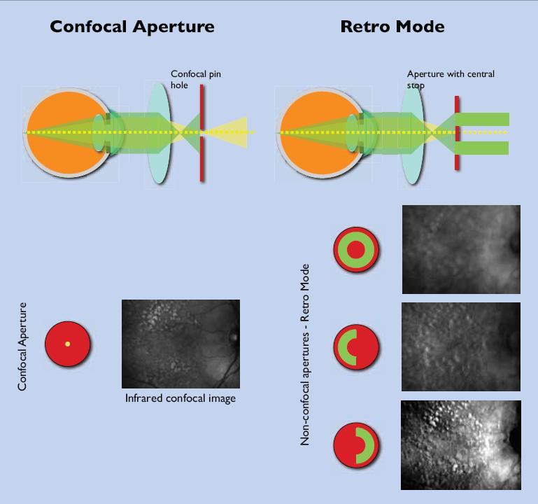 Oświetlenie konfokalne Comparison between Retro-mode and OCT map in Macular Edema detection, C.