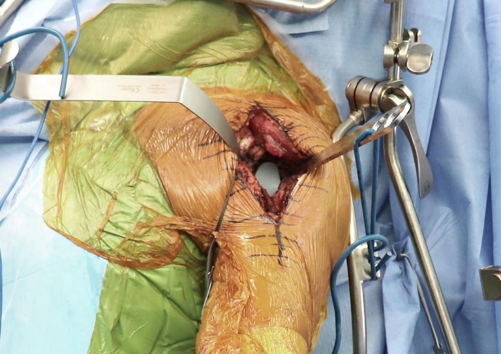Thompson Techniques: SHOULDER EXPOSURE USING HIP SYSTEM FRAME Throughout my career I have always clipped my retractors to the drapes, only to re-adjust several times during the shoulder