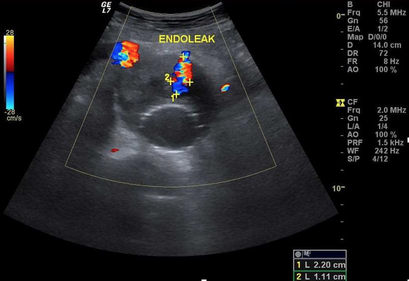 FIGURE 2 Percent of endoleaks detected by precontrast ultrasound (A), postcontrast Doppler and B flow imaging (B), contrast enhanced ultrasound (C), and computed tomography angiography (D) at 6 month
