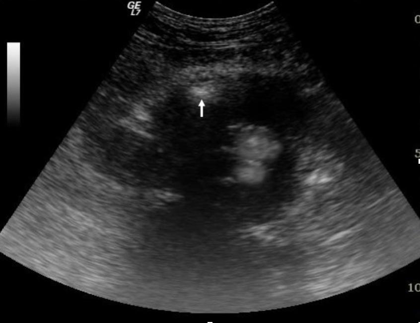 62 25 0 A B C D FIGURE 3 Type IIA endoleak to the anterior portion of the aneurysm sac in color coded Doppler presentation (transverse view); precontrast ultrasound at 6 month follow up FIGURE 4 Type