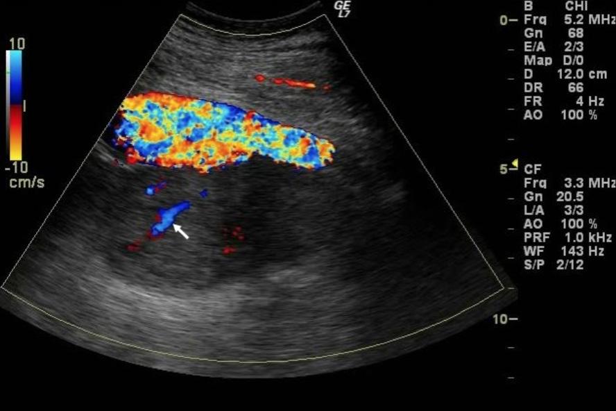 FIGURE 5 Type IIB endoleak to the posterior part of the aneurysm sac (arrow) in color coded Doppler presentation (longitudinal view). Postcontrast ultrasound at 6 month follow up.