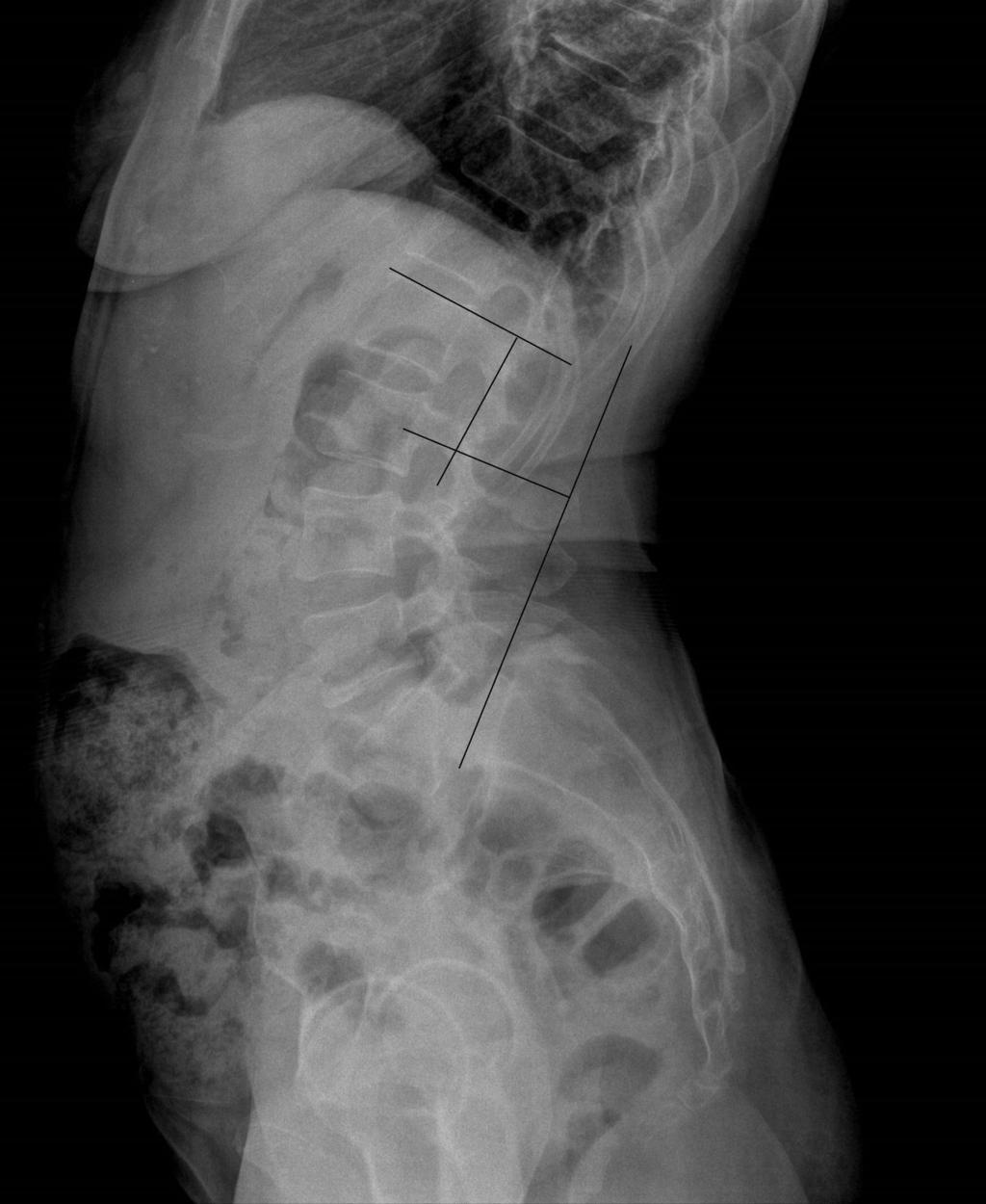 Lumbar lordosis increases with