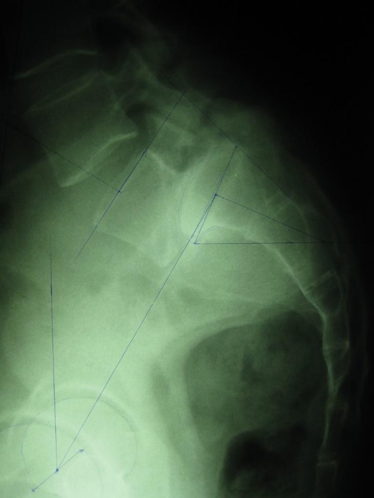 Balanced pelvis 66 o 32 o Hresko MT, Labelle H, Roussouly P, Berthonnaud E.