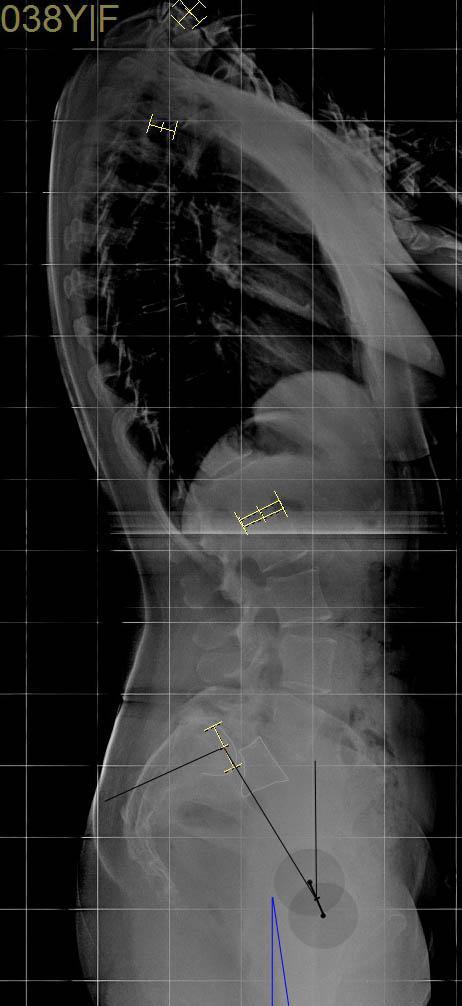 WYSOKIEGO STOPNIA (III, VI) Typ IV BALANCED PELVIS Typ V UNBALANCED PELVIS + BALANCED