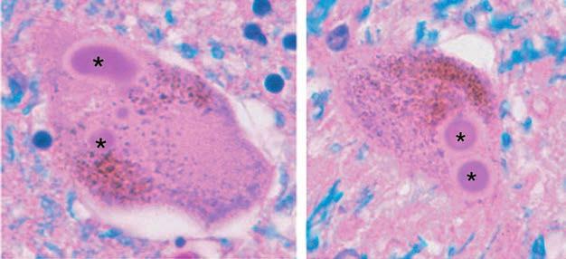 2 1 Choroba Parkinsona definicja i epidemiologia choroby cechę neuropatologiczną [2]. Ciała Lewy ego to eozynofilne wtręty cytoplazmatyczne ( ryc. 1.1). Zawierają synukleinę, ubikwitynę i proteasomy.