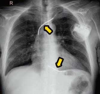 38 Ryc. 1. RTG klatki piersiowej u pacjenta ze wszczepionym jednojamowym kardiowerterem-defibrylatorem (ICD-VR) cy CIED tzw. telemonitoring.