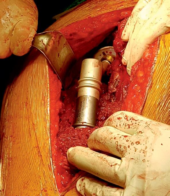 czasu zakończenia wzrostu musieli przechodzić kilka rewizji z wymianą implantu na większy.