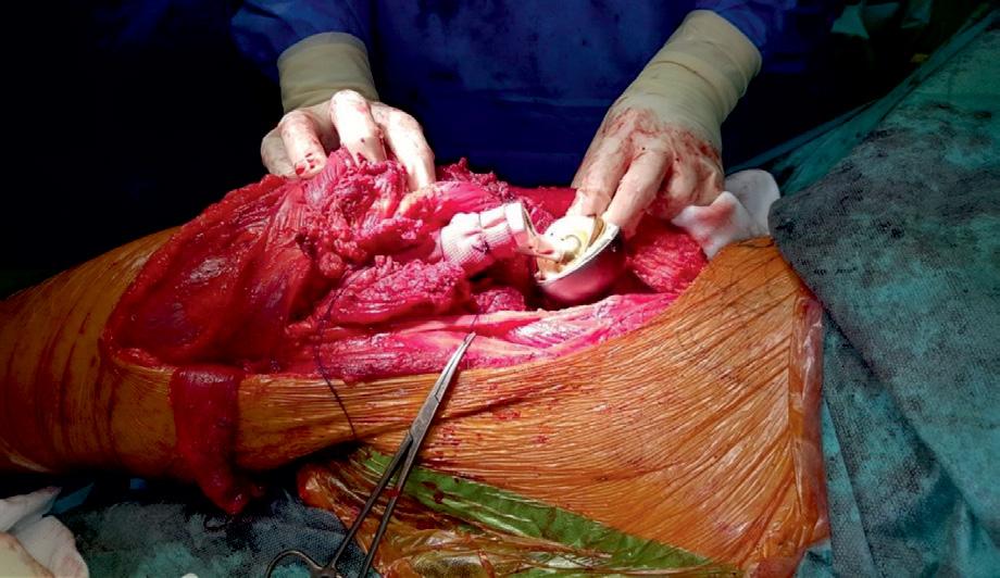 Chondroblastoma kości biodrowej:.