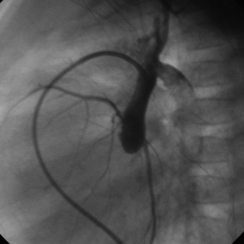 inflow cessation by a balloon catheter (Figure 2).