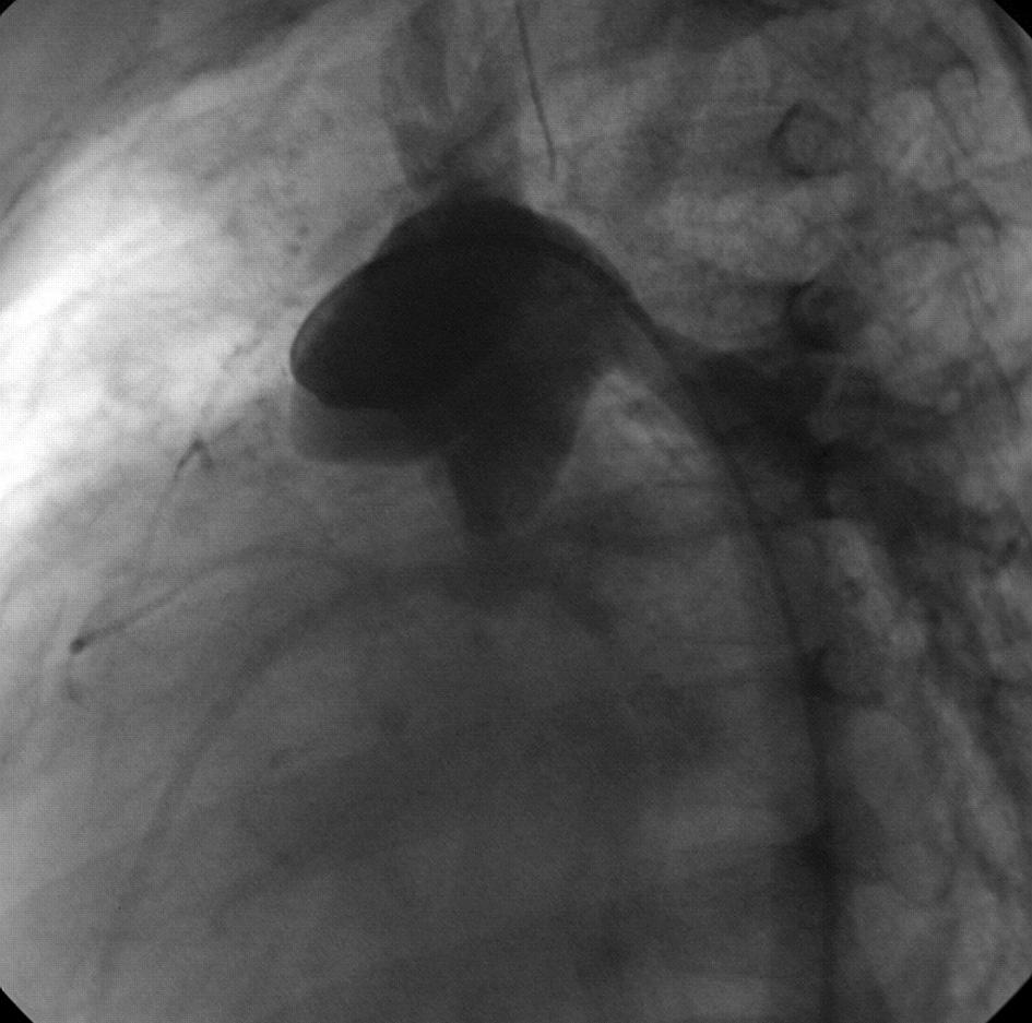 A B C Fig. 4. Balloon angioplasty with Palmaz-Genesis stent implantation for stenosed aortic arch/isthmus in patient with HLHS after Norwood operation.