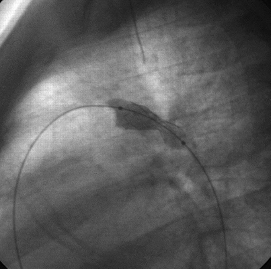 Angioplastyka balonowa zwężenia łuku lub cieśni aorty z implantacją stentu Palmaz-Ge nesis u pacjenta po leczeniu metodą Norwooda.