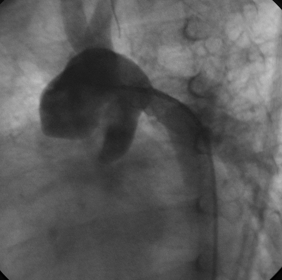 treated successfully in 7 of the 8 infants (87%). Percutaneous balloon angioplasty was sufficient in 5 cases (62%), while in 2 cases (25%) intra-arterial stents were implanted into the Sano shunt.