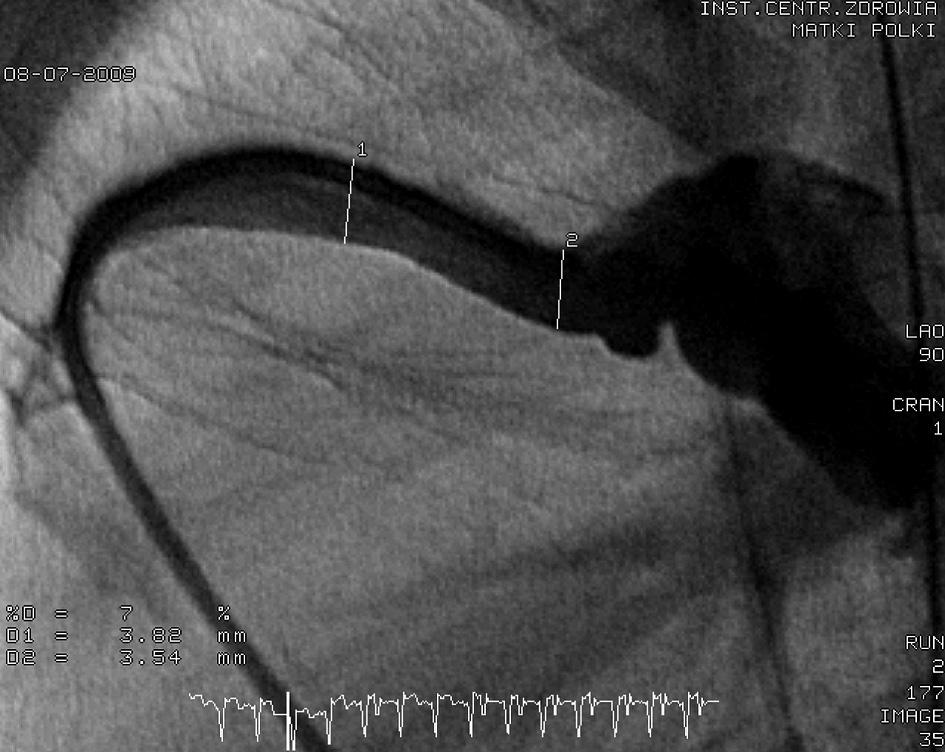 Number of patients 10 9 8 7 6 5 4 3 2 1 0 45% 20% 35% < 5 5-10 > 10 Systolic pressure gradient [mmhg] Fig. 5. Systolic pressure gradient after interventional dilatation of stenosed aortic arch/isthmus Ryc.