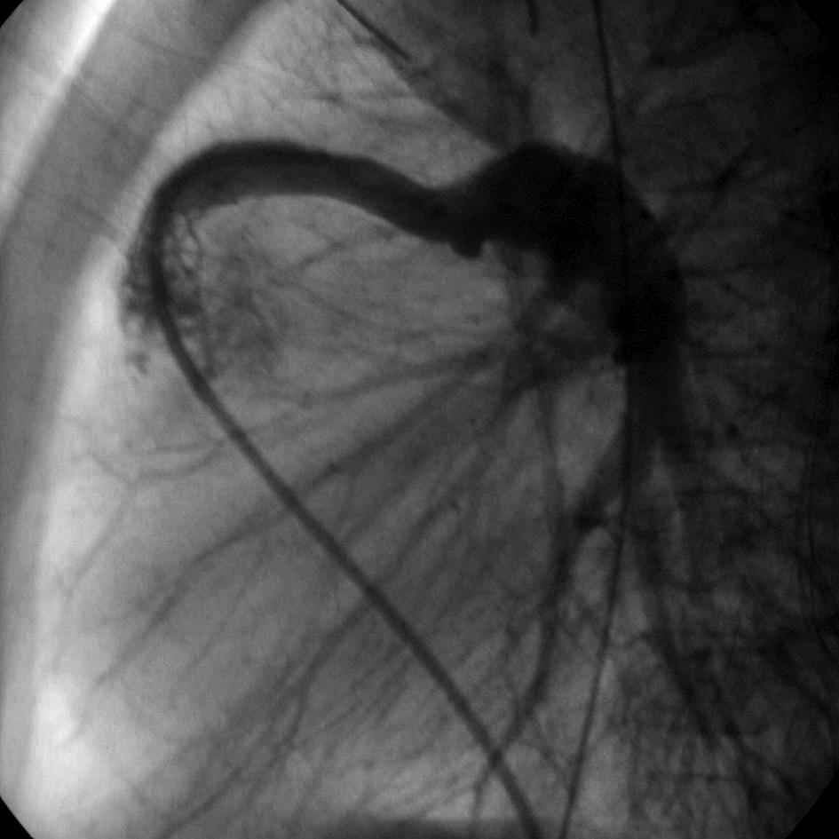 arch/isthmus stenosis exceeds 10 mmhg [1, 3, 6].