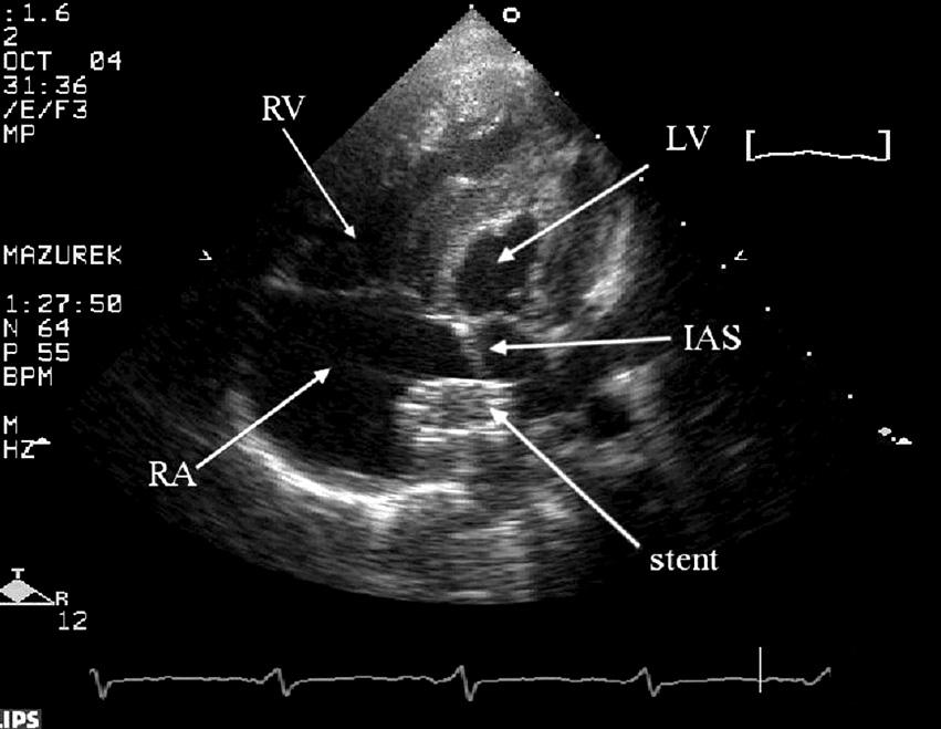the tricuspid valve regurgitation. The end-point for intervention was defined as reduction of the direct gradient by at least 70% in comparison to the baseline values or as gradient reduction 10 mmhg.