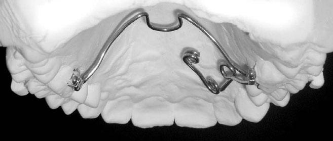 Beata Rucińska-Grygiel tów ze zgryzem przewieszonym powstałym na tle nieprawidłowego ustawienia osi zębów stosuje się wyciągi elastyczne cross-cross [14], łuki podniebienne [15, 16, 17], mini
