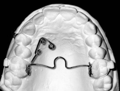 Dobór odpowiedniej metody leczenia zależy od ilości zębów objętych wadą, głębokości zachodzenia zęba przewieszonego na ząb przeciwstawny, akceptacji metody przez pacjenta, poziomu jego współpracy