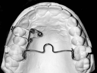 W opisywanych przypadkach zastosowano aparat o następującej budowie: łuk podniebienny doginano z drutu stalowego sprężysto-twardego o przekroju okrągłym 0,9 mm.