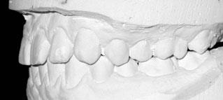 Non surgical correction of severe Class II malocclusion (Brodie Syndrom). Angle Orthodontics. 1990;60(4):299 304. [4] Geiger A., Hirschfeld L. Minor tooth movement in general practice. The C. V.