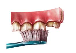 LAKOWANIE ZDROWYCH ZĘBÓW STAŁYCH Powierzchnie żujące zębów trzonowych i przedtrzonowych są, w przypadku zębów stałych, najczęstszym miejscem rozwoju próchnicy.