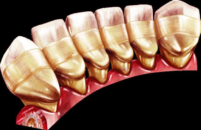 Przykłady zastosowań WŁÓKNA KOMPOZYTOWEGO WŁÓKNO KOMPOZYTOWE eliminuje konieczność nakładania trzech odrębnych warstw dzięki czemu każdy skomplikowany zabieg szynowania zębów staje się prosty.