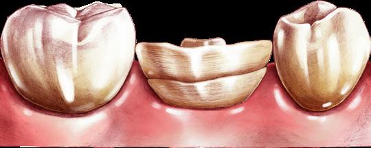Szyna stabilizująca rozchwiane zęby wykonana z WŁÓKNA KOMPOZYTOWEGO WŁÓKNO KOMPOZYTOWE modeluje się jak typowe wypełnienie kompozytowe, dzięki czemu każdy skomplikowany zabieg rekonstrukcji staje się