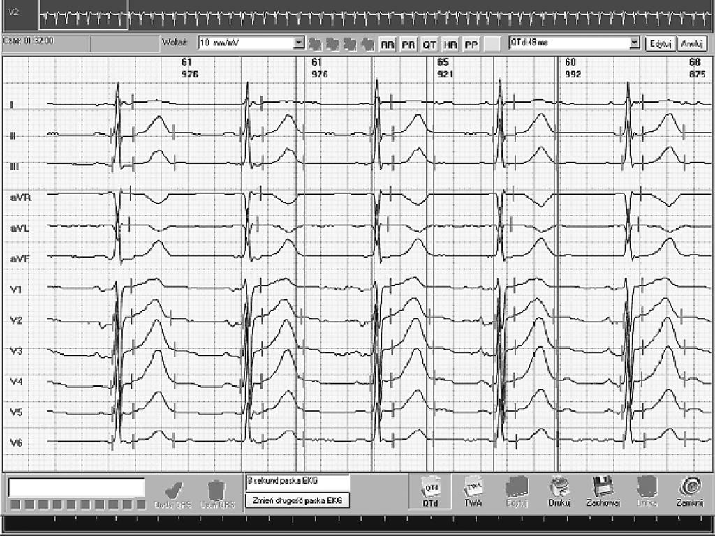 L. Markuszewski i wsp., Zmienność dobowa dyspersji QT u pacjentów z chorobą wieńcową Rycina 1. Sposób pomiaru dyspersji QT.