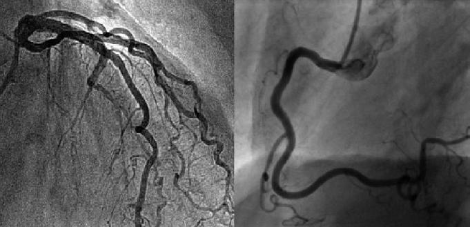 Folia Cardiologica 2017, tom 12, supl. Rycina 3,. Prawidłowy obraz tętnic wieńcowych w koronarografii C D Rycina 4 D.