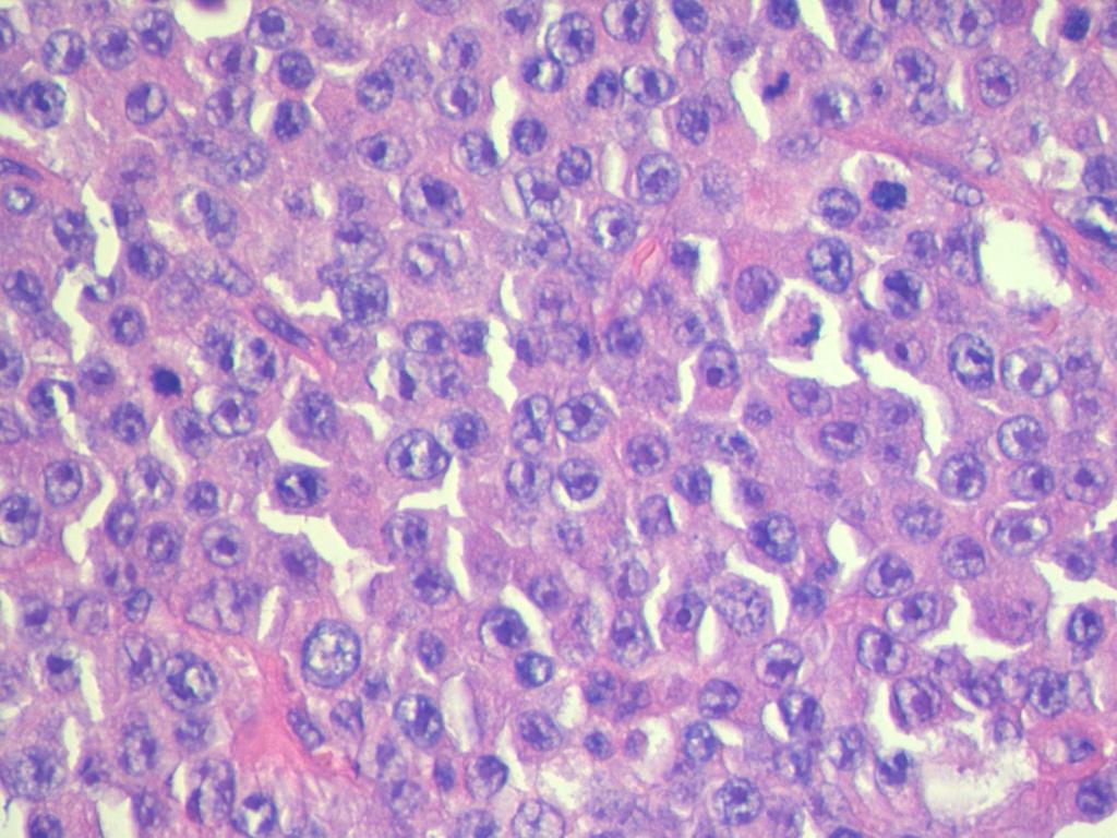 694 M. KRAJ i wsp. Ryc. 1A. Chłoniak plazmoblastyczny, duŝe komórki przypominają immunoblasty (barwienie H+E, duŝe powiększenie) Fig. 1A. Plasmablastic lymphoma, large cells resembling immunoblasts (H+E staining, high magnification) siła 146 komórek/µl, z obecnością 90% komórek o fenotypie plazmocytów.